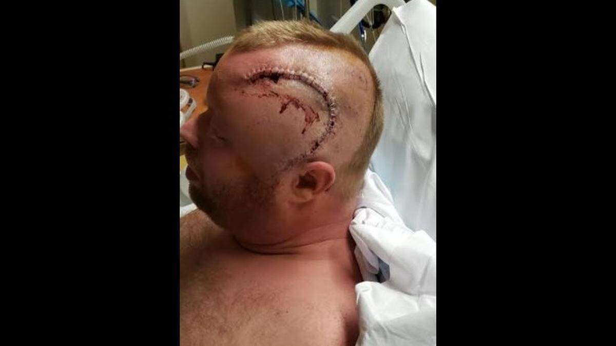 Allen Vann, a firefighter in Midway, Ky., had a cancerous tumor removed from his head earlier this year. The tumor was the size of a lime, Vann said.