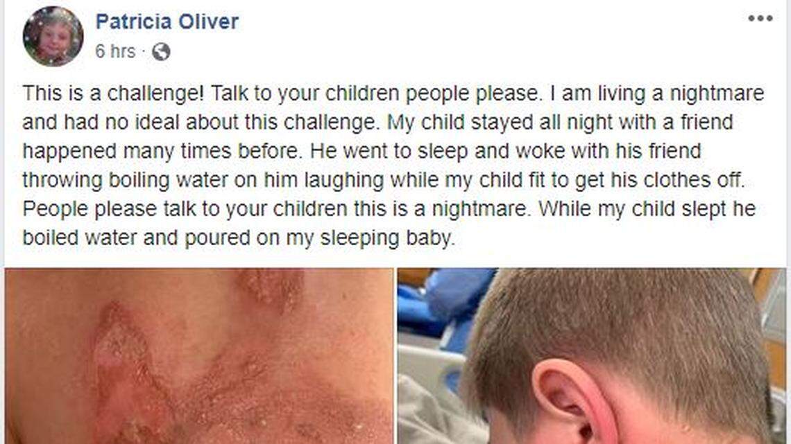 Billy Oliver, 11, was sent to the Cincinnati Burn Center after his friends reportedly poured boiling water on him for the “Hot Water Challenge.” His mother, Patricia Oliver, urged parents to speak with their children in a public Facebook post.