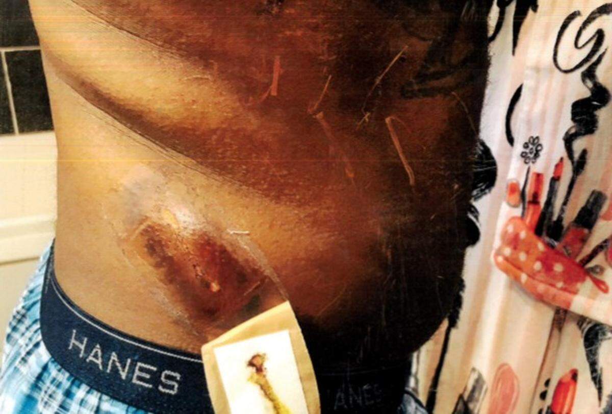 A photograph of an injury to Brian Dumphord’s side was included in the federal lawsuit case file. The injury is from a bite by KSP canine Pluto, according to Dumphord’s lawsuit.