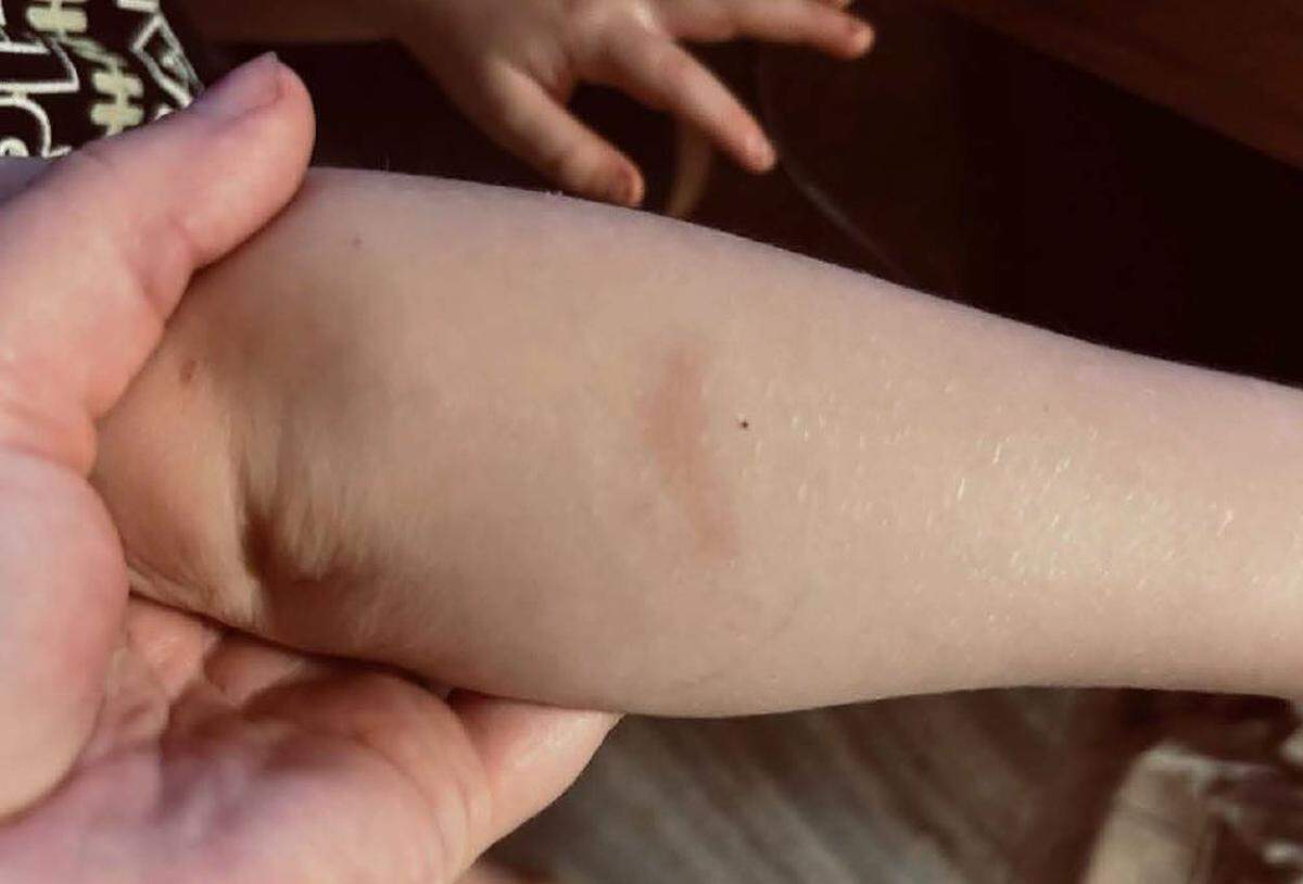 A bruise allegedly remained on a child’s arm a week after a July 2024 incident at the YMCA Crayon Club in Maysville.