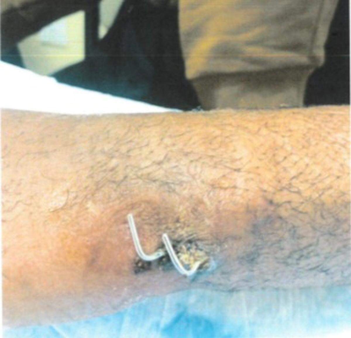 A photograph of an injury to Brian Dumphord’s wrist was included in his federal lawsuit case file. Dumphord complained of the injury, which he said was caused by a bite from KSP canine Pluto, but troopers would not remove handcuffs, he said.