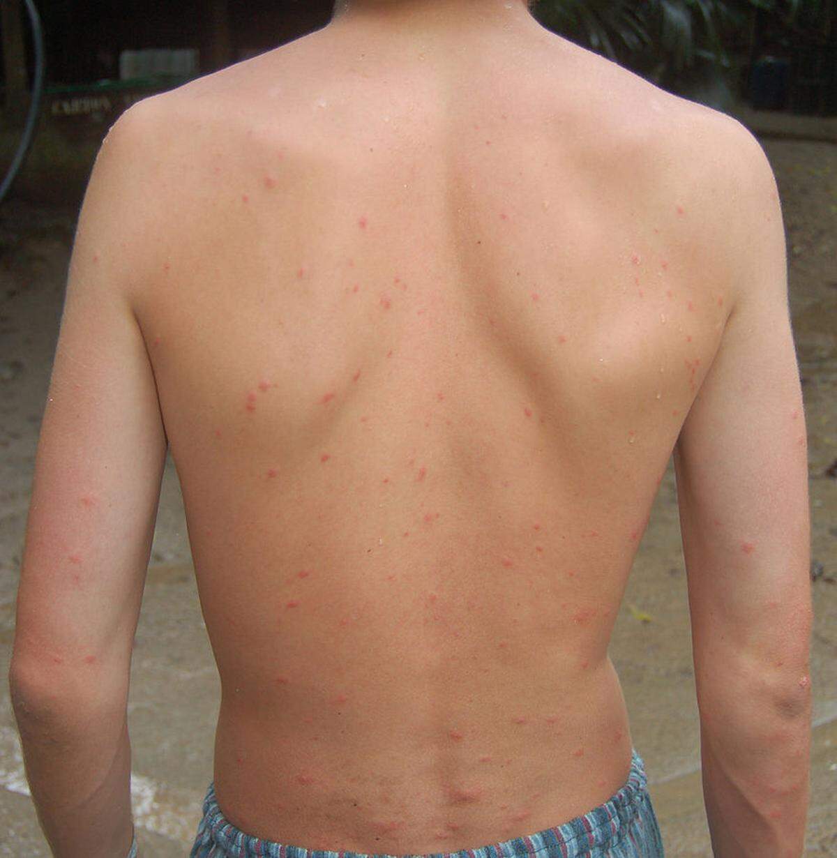 A mosquito-bitten back after passing a night in Colombia’s Tayrona National Natural Park. The bites broke through a shirt, bed sheet and hammock. Photo shared under Creative Commons Share Alike license via Wikimedia Commons. https://commons.wikimedia.org/wiki/File:Mosquito_back.jpg