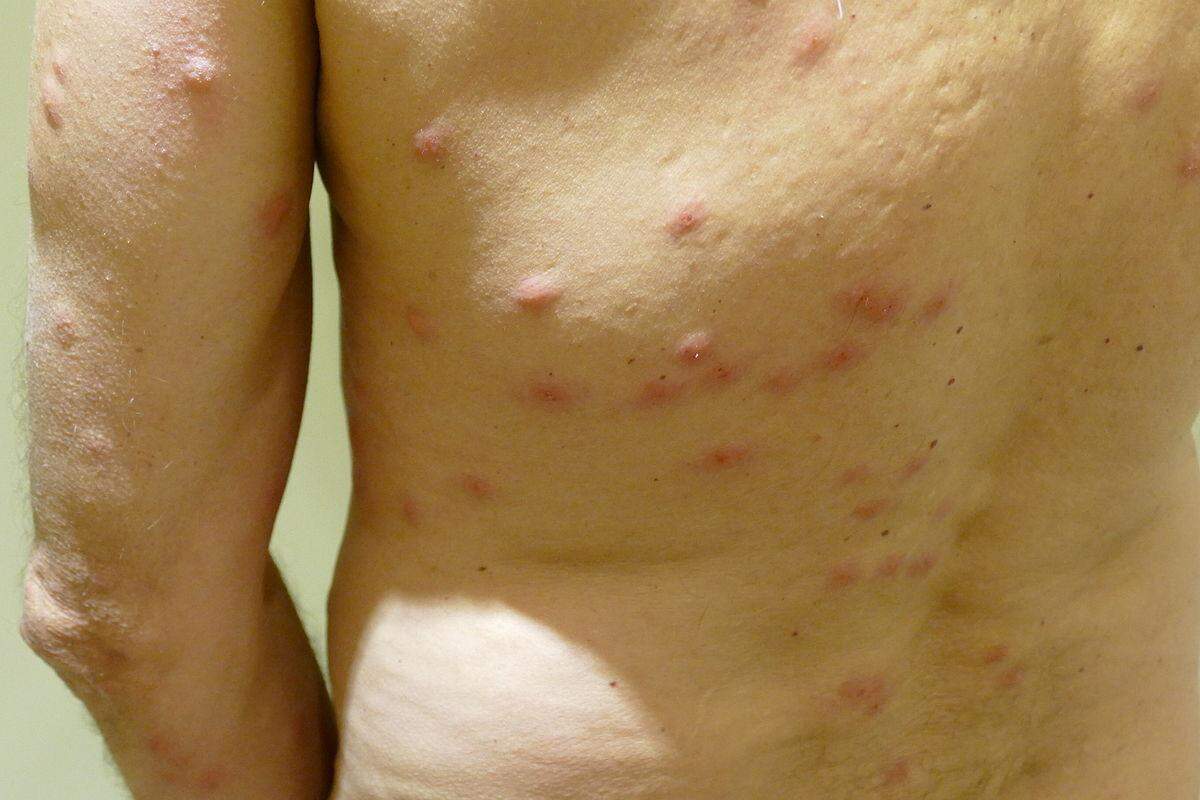 Bed bug bites from an Amsterdam hotel. Photo is in the public domain under CC0 1.0 Universal Public Domain Dedication, sourced via Wikimedia Commons: https://commons.wikimedia.org/wiki/File:2015.11.26.192605Cimex_lectularius_bites.jpg