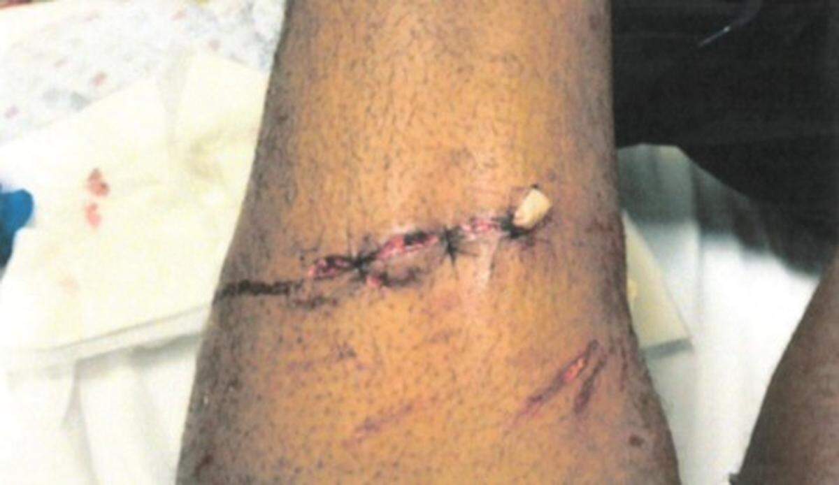A photograph of an injury to Brian Dumphord’s thigh was included in his federal lawsuit file. The injury was from a bite by KSP canine Pluto.