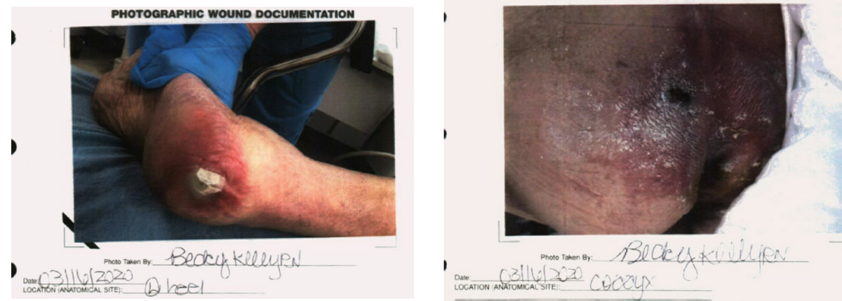 These pressure sores were among those suffered by a woman who lived at Salyersville Nursing and Rehabilitation Center in 2019 and 2020, according to her family’s subsequent wrongful death lawsuit.