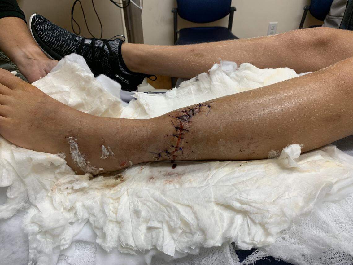 Buchart has overcome multiple leg breaks and surgeries to return to diving.