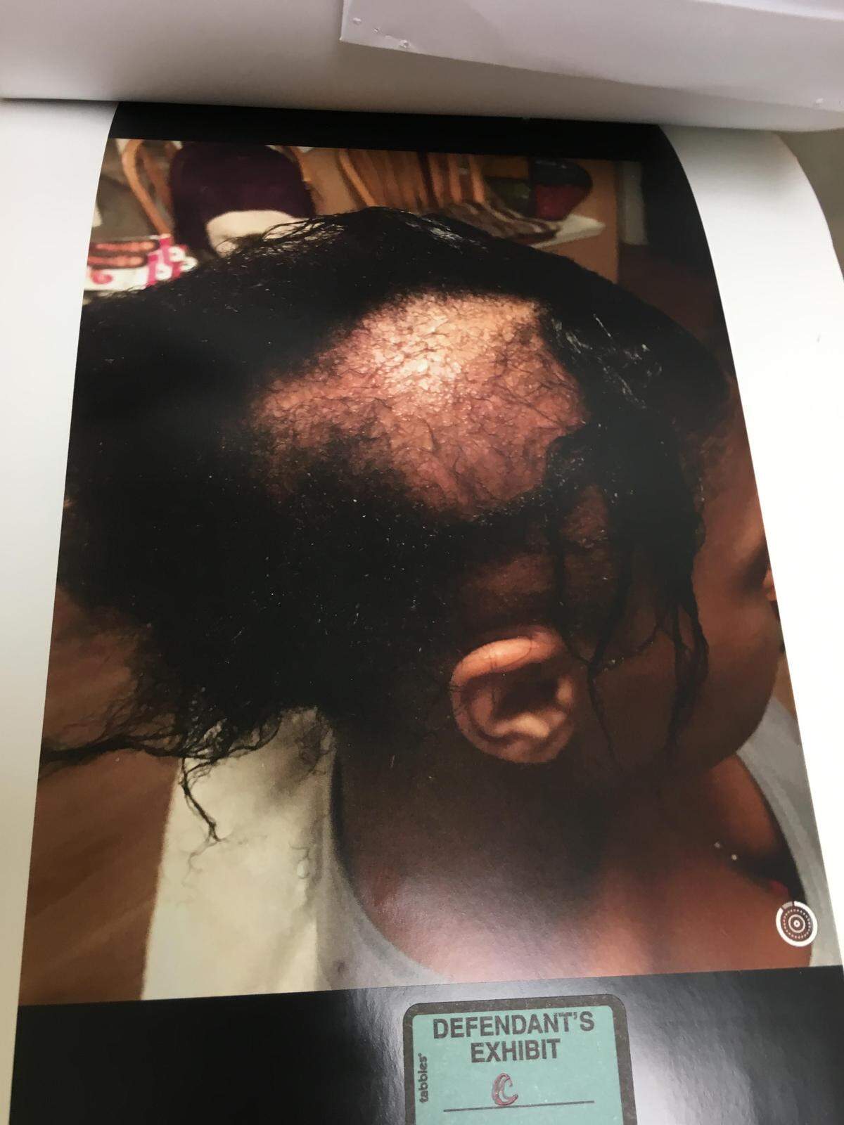 An image of injuries Jackson suffered in an alleged March 2018 attack against her by some of the women who she was accused of shooting at in July 2018 was entered in her case file. Jackson’s hair did not fully grow back after what happened, Jackson’s attorney wrote in court documents.