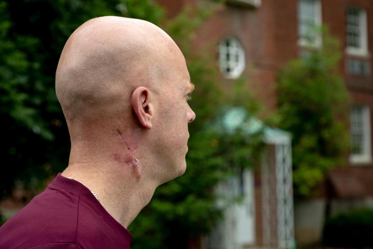 EKU men’s basketball coach A.W. Hamilton, 39, had a cancerous tumor surgically removed from his right ear via incision over the summer.