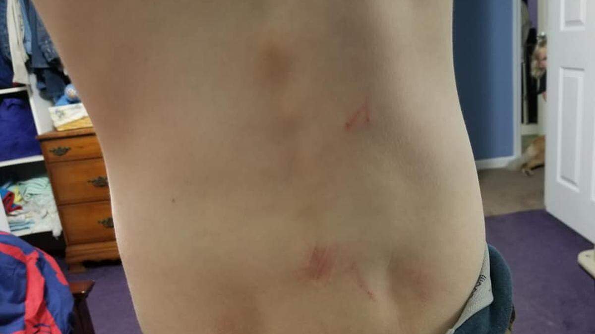 Jo Grayson said her 11-year-old son, who has autism, sustained cuts and bruises when he was dragged down a Tates Creek Middle School hallway by a teacher and a school nurse. Grayson said school district police and child protective service workers are investigating.