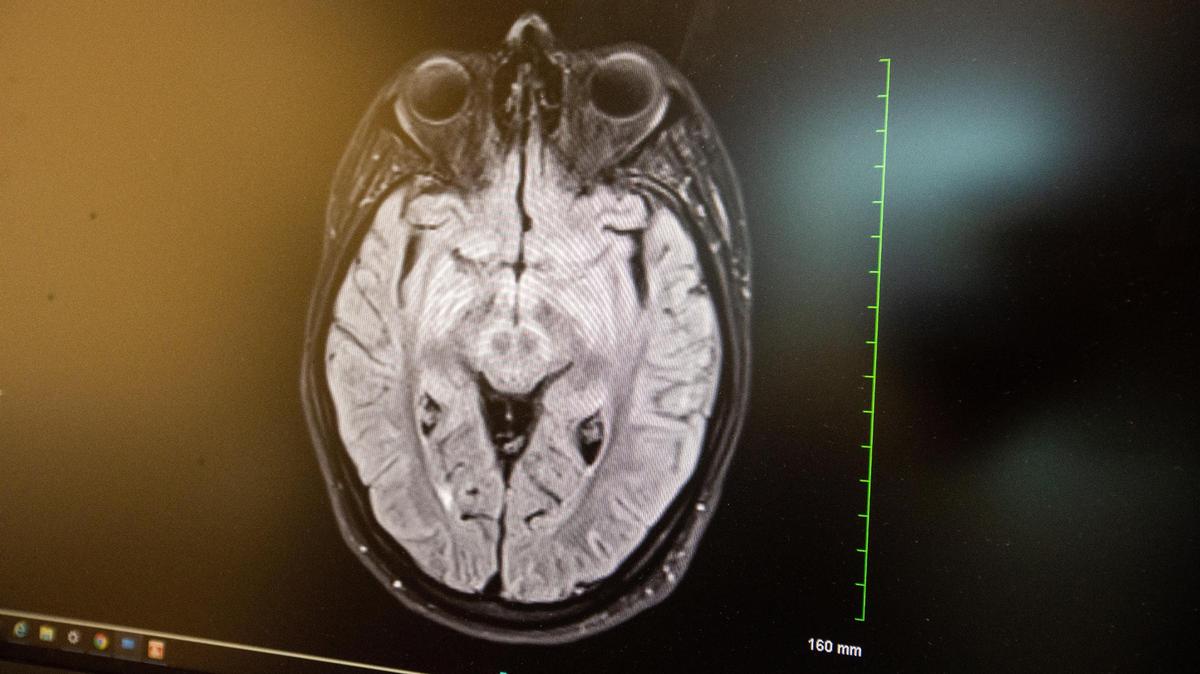 An image of an MRI scan of Kentucky law school student Shelby Ponder displayed on the computer screen of Dr. Daniel O. Lee, Kentucky Neuroscience Institute Medical Director. Shelby had been diagnosed with a swelling in her brain, or encephalitis, after her exposure to the COVID-19 virus. March 9, 2021.