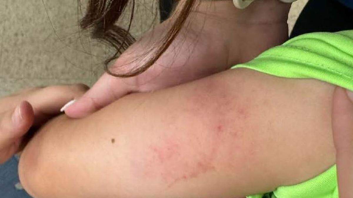 State investigators said a daycare employee in Owensboro roughly grabbed a misbehaving boy by the upper arms on June 20, 2024, and carried him out of the room, leaving bruises on his arms.