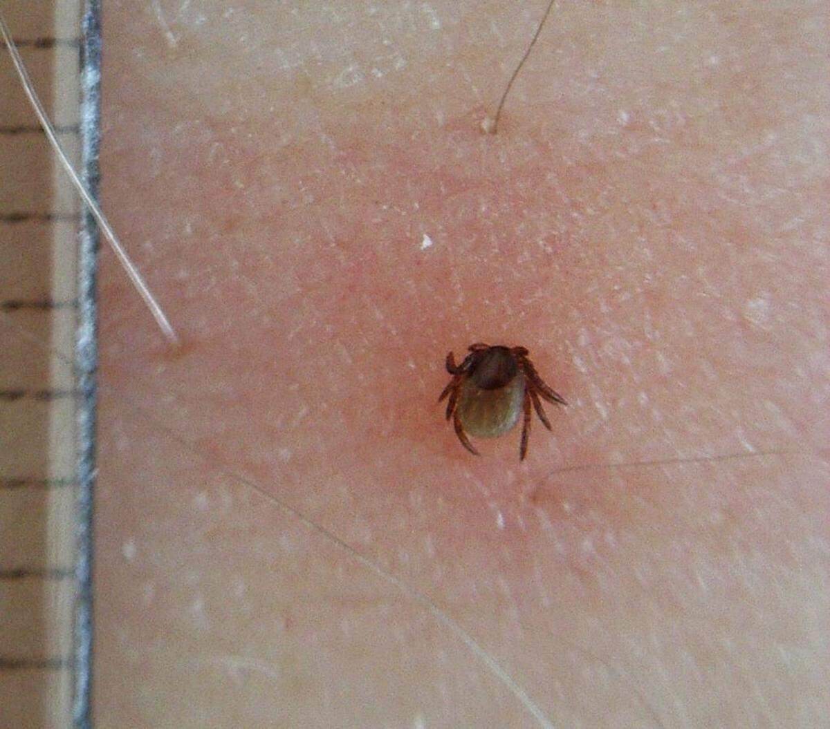 This Wikimedia Commons photo shows a tick biting into the leg of an individual.