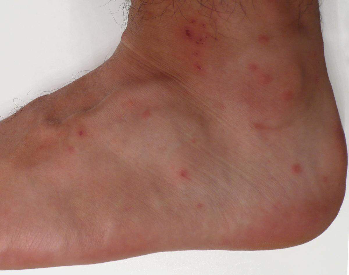 Chigger rash as seen on an ankle, a common spot for bites. Photo is in the public domain, sourced from Wikimedia Commons at https://commons.wikimedia.org/wiki/File:Chigger_bites.jpg 