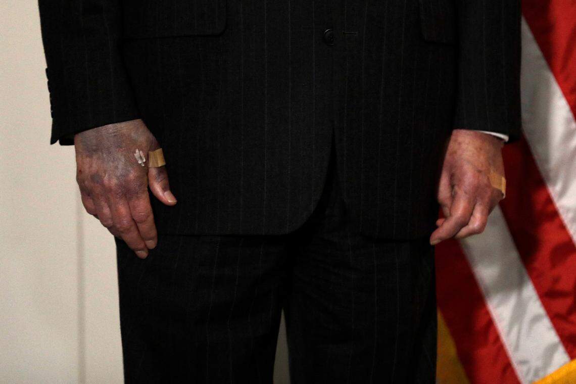 The hands of U.S. Senate Majority Leader Mitch McConnell were seen when he talked to the media this week.