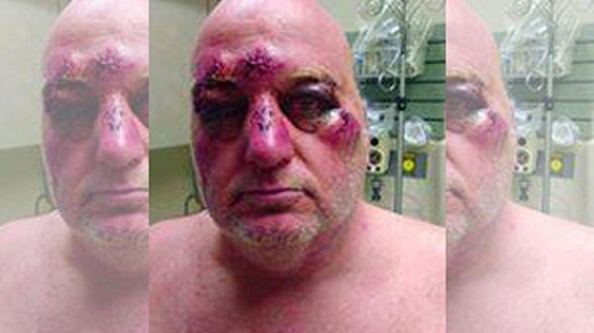 Ronnie Hall after he was beaten by three men he subsequently shot.