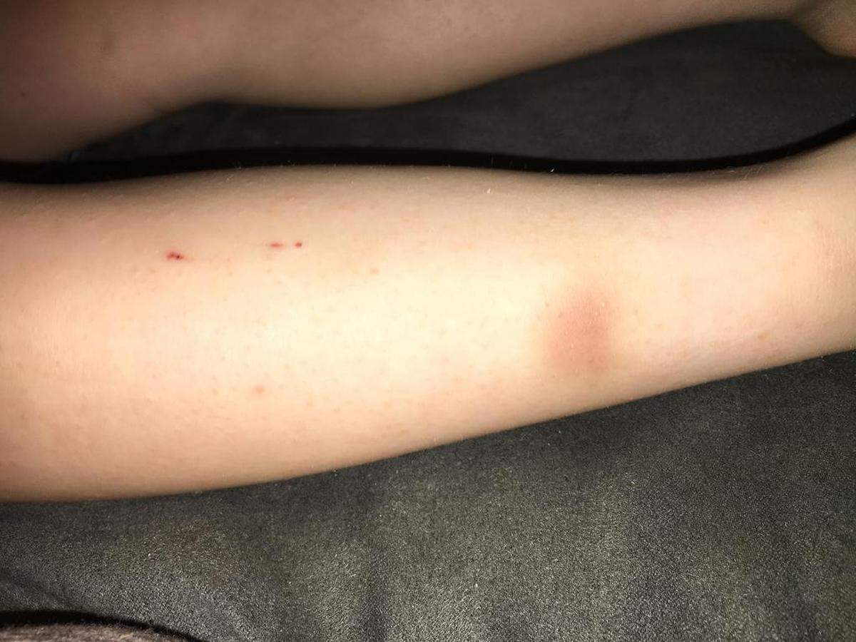 A state investigative report said University of Kentucky medical staff documented contusions and scrapes after a 6-year-old autistic student was allegedly dragged by a teacher’s aide in August at Picadome Elementary.