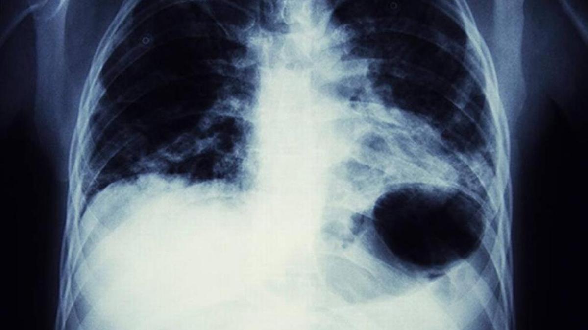 More people die from lung cancer than any other type of cancer. Cigarette smoking is the No. 1 risk factor for lung cancer. Kentucky leads the nation in lung cancer incidence and death.