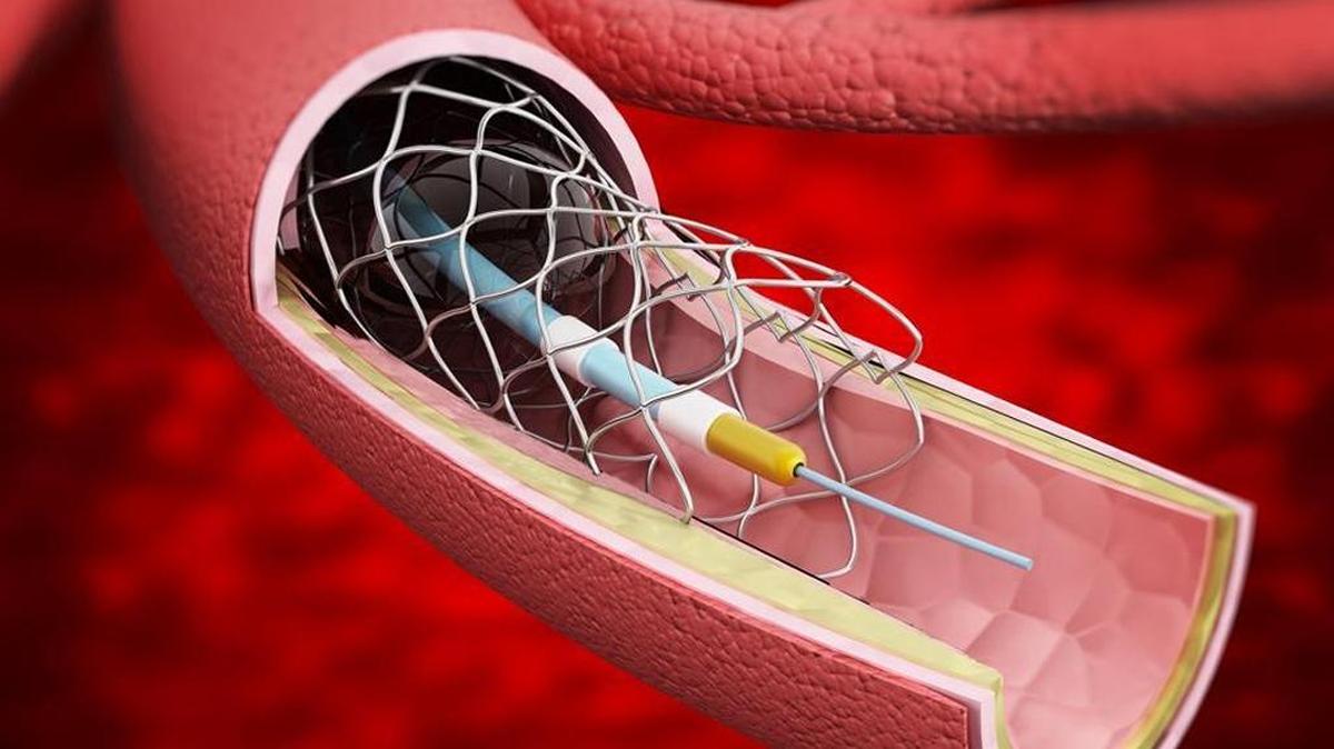Illustration of vascular stent inside the vein