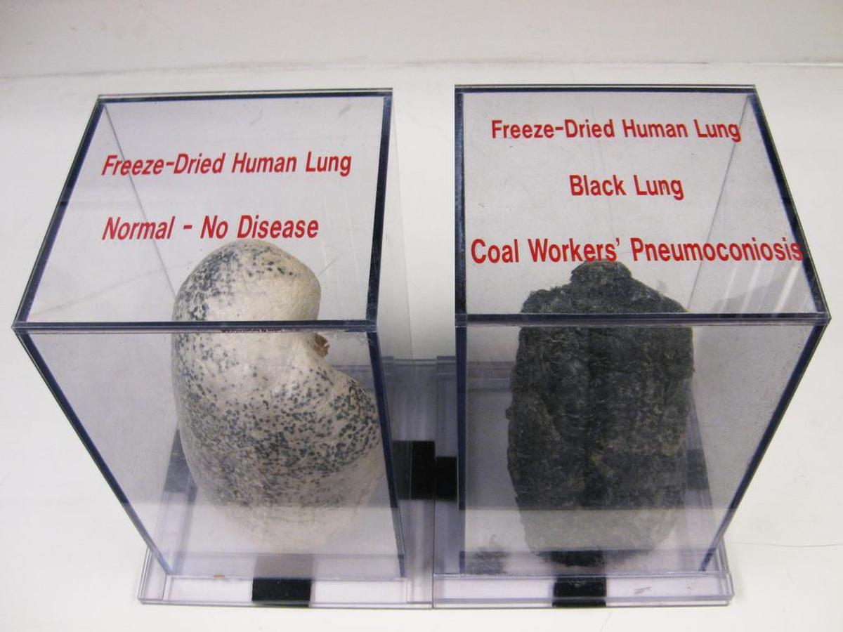 A display case at NIOSH shows a normal lung and a diseased black lung, caused by inhaling coal dust and other harmful particles while coal mining.