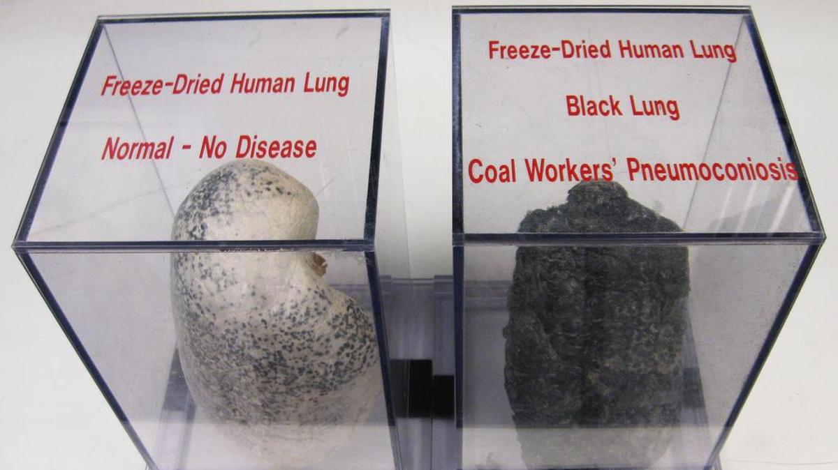 A display case at NIOSH shows a normal lung and a diseased black lung, caused by inhaling coal dust and other harmful particles while coal mining.